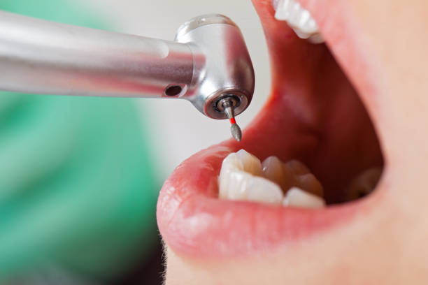 Best Emergency Wisdom Teeth Removal in Thomasboro, IL